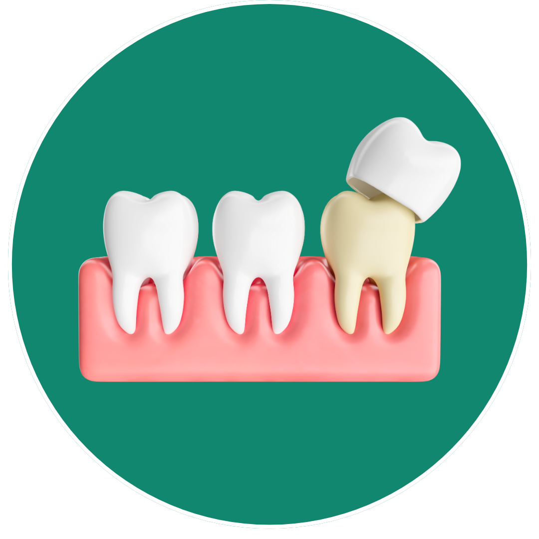 Crowns Dental - Smile Dental Lab